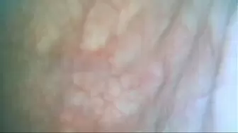 endoscope in my bladder