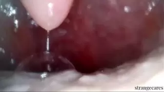 throat endoscopy with some gagging