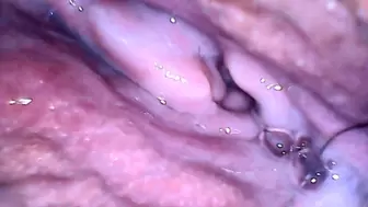 Hairy pee endoscope session