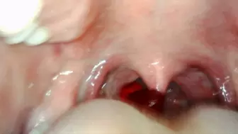 Endoscope gummy vore