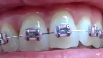 Few minutes of my braces on my top teeth mp4