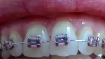6 minutes of my braces on the teeth to cam mp4