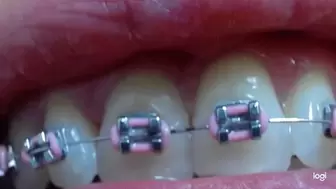 6 minutes my teeth with braces mp4