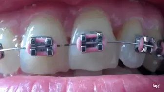 11 minutes of my teeth with braces to cam mp4