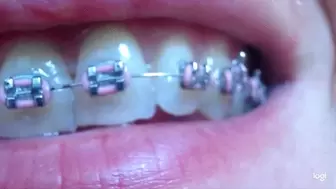 Few minutes of my braces on my teeth mp4