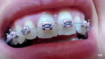 My teeth with braces on them mp4