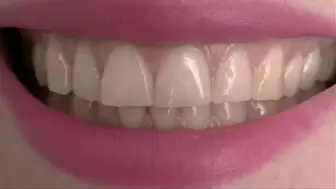 The edges of your incisors are so extremely sharp MP4 HD 720p