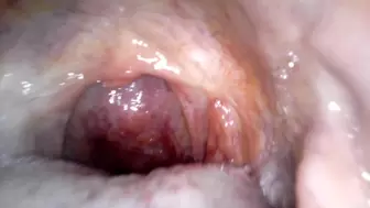 Holy uvula! Endoscope camera used