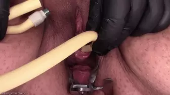 catheter filling and slow orgasmic piss