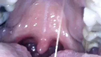 Endoscope throat and uvula views