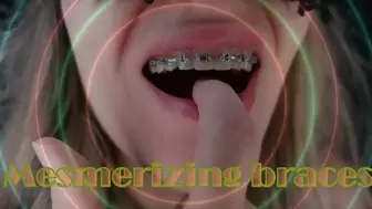 Mesmerizing braces