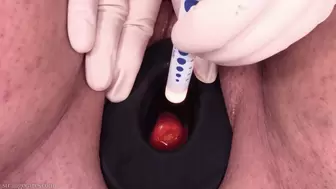 cervix swabbed with iodine (720 mp4)