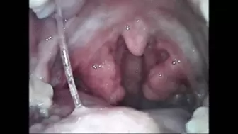 Squeezing the tonsils