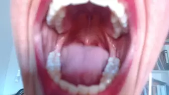flicking uvula & strong gag reflex