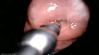 cervix treble sound endoscopy