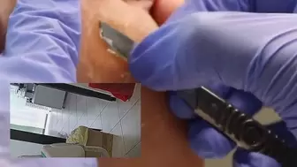 Hardcore medical pedicure
