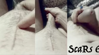 scar fetish - fourth post surgery masturbation withOUT bandages
