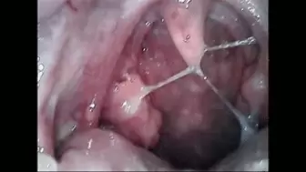 Phlegm endoscopy of the throat & nose
