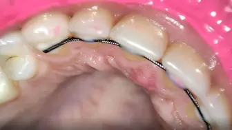 permanent retainers mouth tour