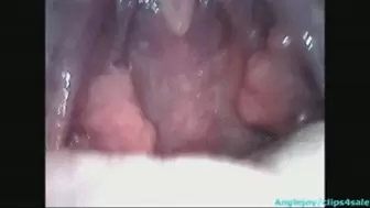 Endoscopy of sperm in the throat wmv