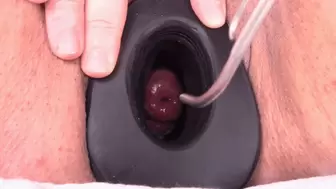 tenaculum in my cervix - first time (720 wmv)