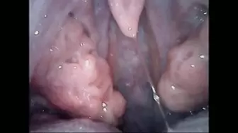 Monstrous tonsils after virus